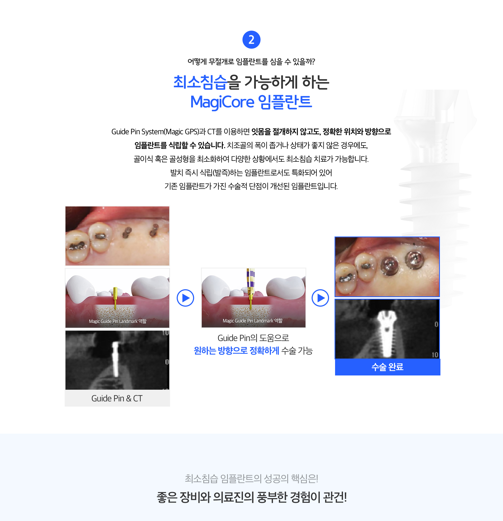 최소침습을 가능하게 하는 magicore 임플란트