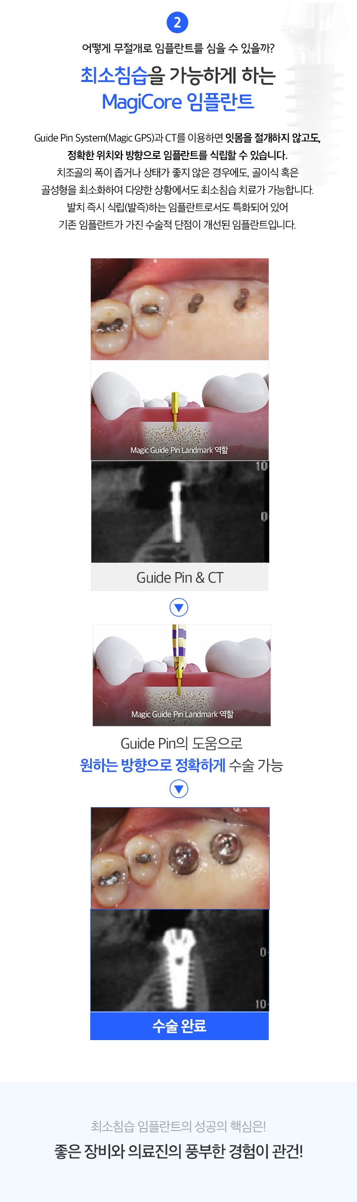 최소침습을 가능하게 하는 magicore 임플란트