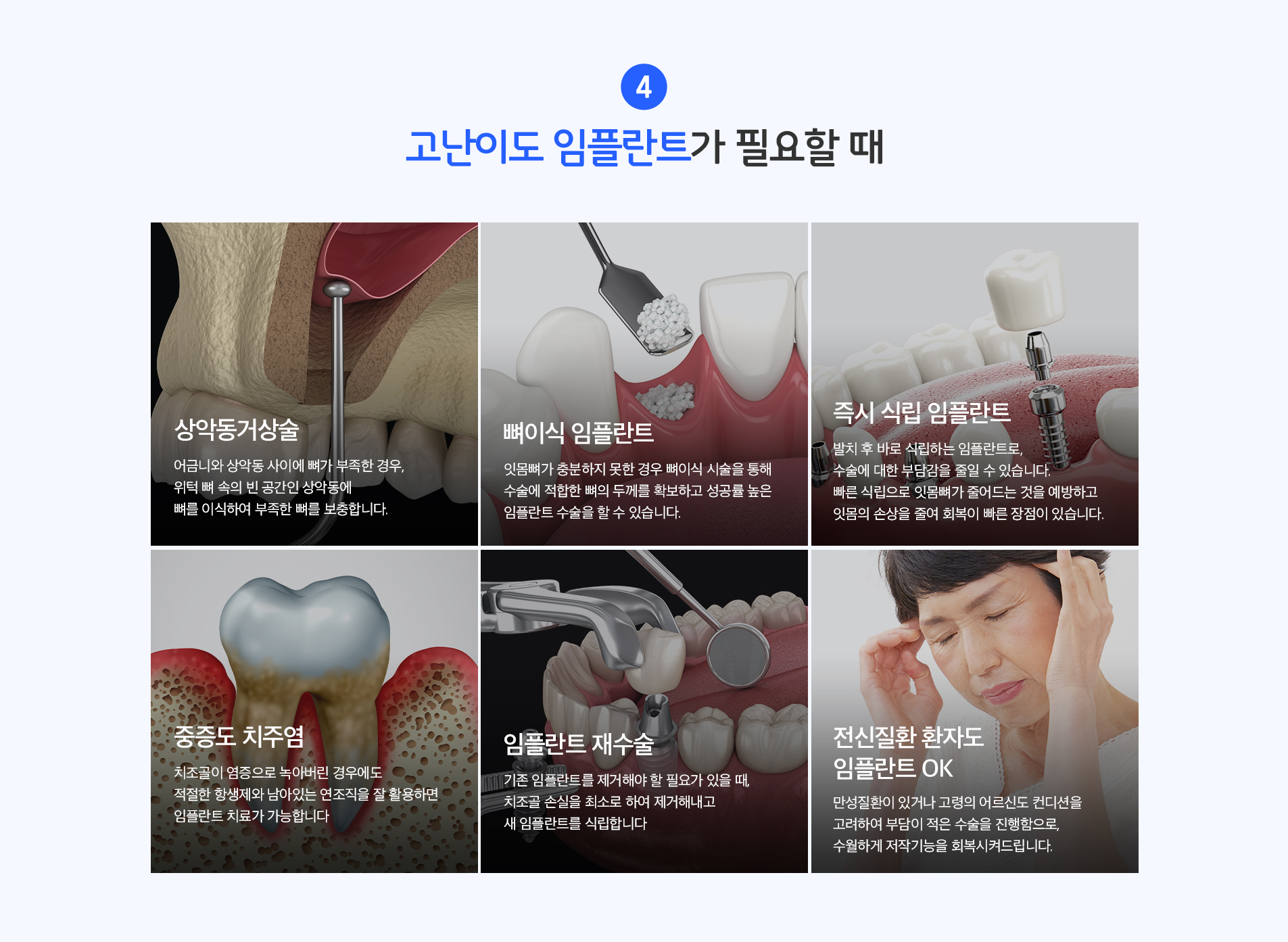 고난이도 임플란트가 필요할 때