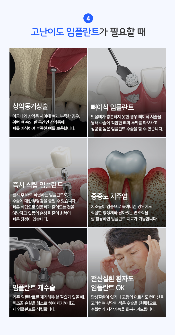 고난이도 임플란트가 필요할 때